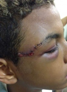 The bullet hit the teenager in the forehead.