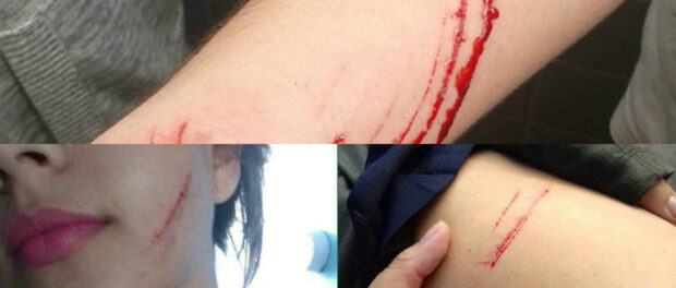 Some of the injuries sustained by students at Mendes do Moraes during the week of attacks